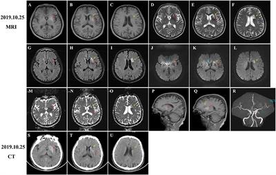 Diabetic Striatopathy Complicated With Acute Ischemic Stroke: A Case Report